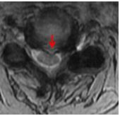 Bright on GE MRI means herniation